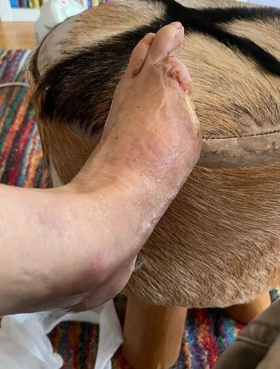 Jacques Breuer koju pirstai